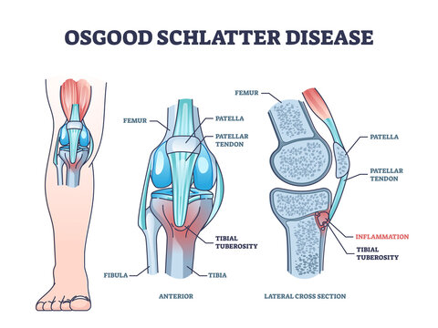 Osgood schlatter disease condition with leg and knee joint pain outline diagram. Labeled educational medical scheme with patella tendon inflammation and tibial tuberosity anatomy vector illustration.