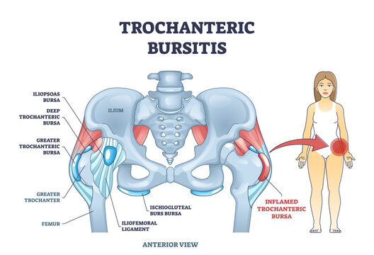 Trochanteric bursitis as bursa inflammation located in hip outline diagram. Labeled educational medical anatomy scheme with iliopsoas and deep greater trochanteric bursa types vector illustration.