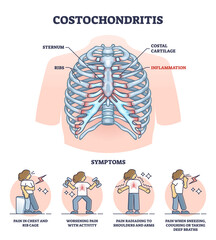 Costochondritis as chest wall pain or costosternal syndrome outline diagram. Labeled educational medical scheme with ribcage cartilage inflammation and painful condition symptoms vector illustration.