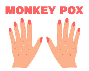 Banner with smallpox monkey. Monkey pox. Hands with a rash. Smallpox symptom. Vector illustration.