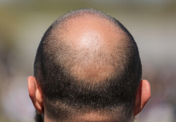 Bald patch on the head of a man.