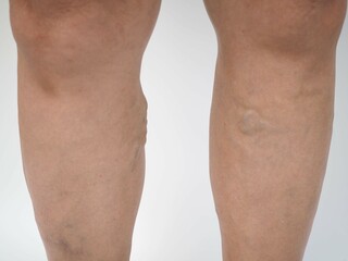 Varicose veins on a leg. closeup photo, blurred.