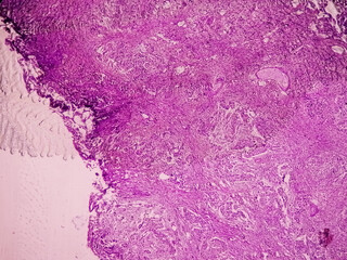 Bladder Cancer: High grade transitional cell carcinoma (TCC), Urothelial carcinoma