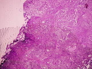 Bladder Cancer: High grade transitional cell carcinoma (TCC), Urothelial carcinoma