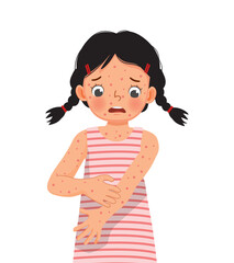 cute little girl scratching her itchy suffering from measles rash allergy skin - obrazy, fototapety, plakaty