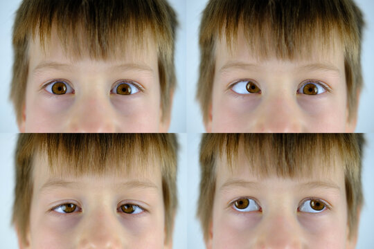 close-up of part of child's face, brown eyes of boy 8-10 years old brown eyes look up, little patient with strabismus, concept of happy childhood, diagnosis, treatment of ophthalmic diseases