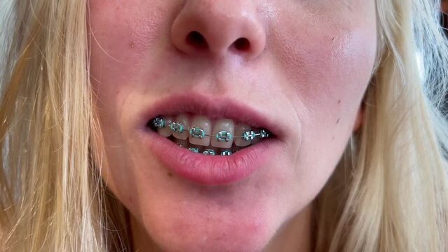 Teeth with braces. Dental care concept. Close-up of a wide smile of a girl with braces on snow-white teeth. The concept of caring for teeth and oral cavity. Problems with bite, alignment of teeth.