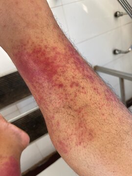   scleroderma skin disorder autoimmune.