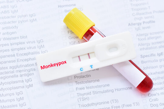 Monkeypox positive, blood test for Monkeypox virus by using rapid test kit, the result showed positive