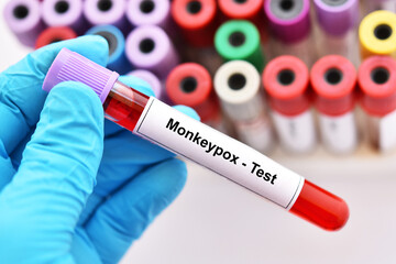 Obraz premium Blood sample tube for Monkeypox virus test, new epidemic disease in 2022