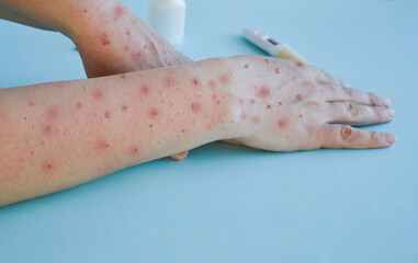Monkey pox virus, a new world problem of modern humanity. Close-up of the hands of a sick person...