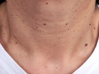 Neck of a woman with many small moles and warts