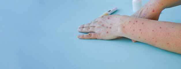 Monkey pox virus, a new world problem of modern humanity. Close-up of the hands of a sick person with pimples and blisters wild banner. Smallpox vaccine.