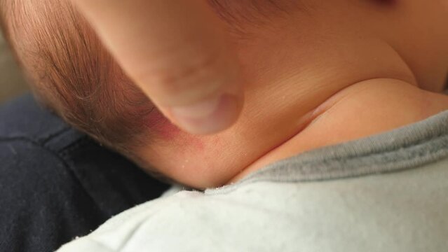 stork bite, angel kiss, nevus simplex, birthmark on newborn skin, back of head, neck