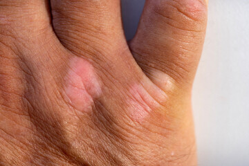 Close up of psoriatic plaque on the masculine hand