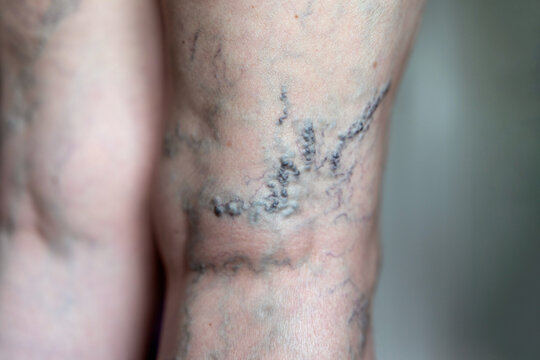 Close up of female leg with extensive varicosity on popliteal region