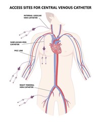 PICC Line insert neck tube vein arm blood draws heart IV needle cancer therapy Total peripheral internal double lumen chest port fluid injection large artery superior vena cava care drug implantation - obrazy, fototapety, plakaty
