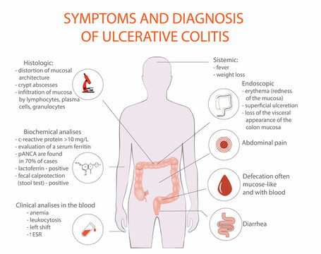 Symptom of ulcerative colitis, vector, medical diagram