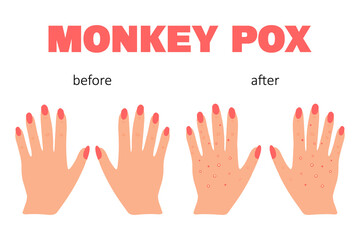Banner with smallpox monkey. Monkey pox. Hands with a rash. Smallpox symptom. Vector illustration.