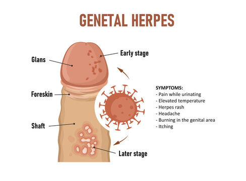 Genital herpes. Herpes simplex virus