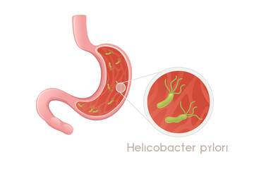 Human Stomach with helicobacter pylori cartoon design human anatomy organ vector illustration on white background