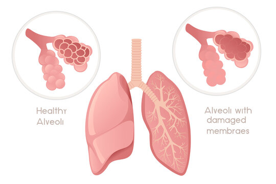 Human Lungs alveoli with damaged membrane cartoon design human anatomy organ vector illustration on white background