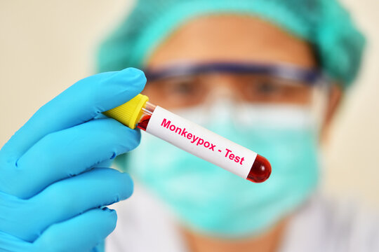 Monkeypox test, lab technician holding blood sample tube for Monkeypox virus test