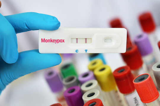 Monkeypox positive, blood test for Monkeypox virus by using rapid diagnostic kit, the result showed positive