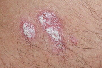 Fototapeta premium problem skin psoriasis on the body. Psoriasis is an autoimmune disease that affects the skin causing red, scaly skin inflammation.