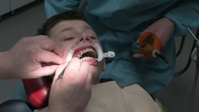 An orthodontist applies braces to a student's teeth, crooked children's permanent teeth, and a white plastic retractor on his lips.
