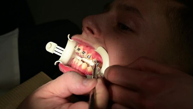 Installation of braces on the crooked teeth of the child, a white retractor on the lips to facilitate the work of the orthodontist.
