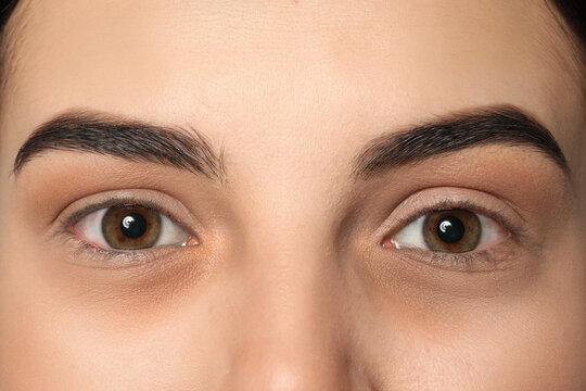 Tired Young Woman With Dark Circles Under Eyes, Closeup