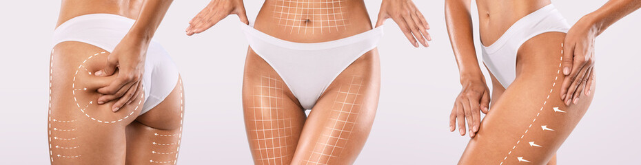 Liposuction. Set Of Slim Lady Figures With Lifting Up Lines On Body