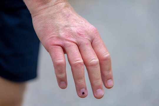 Healthcare and medical concept, Selective focus of little bit swollen hand, A man show right hand side with swelling from insect or bug bite in the forest.