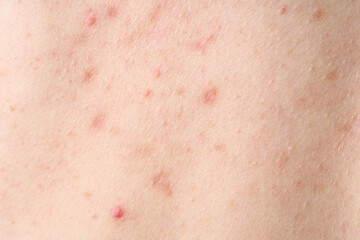 Skin with acne, with red spots. Health problem, skin diseases. Close up Allergy rash. Dermatitis problem of rash. 