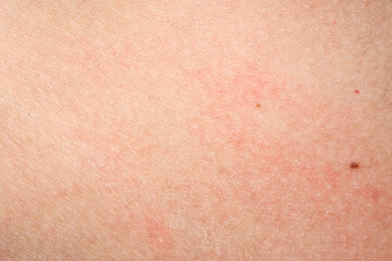 Skin with acne, with red spots. Health problem, skin diseases. Close up Allergy rash. Dermatitis...