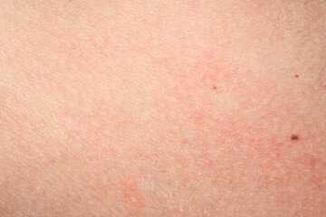 Fototapeta premium Skin with acne, with red spots. Health problem, skin diseases. Close up Allergy rash. Dermatitis problem of rash. 