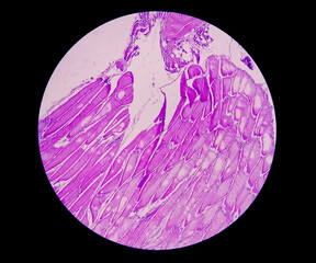 Microscopic view of histological tissue study showing Rhabdomyoma.