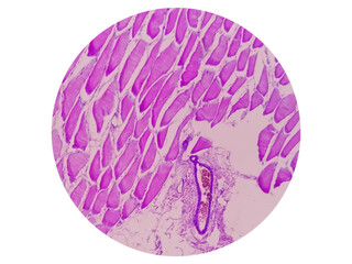 Microscopic view of histological tissue study showing Rhabdomyoma.