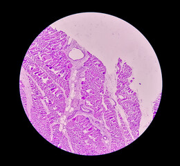 Microscopic view of histological tissue study showing Rhabdomyoma.