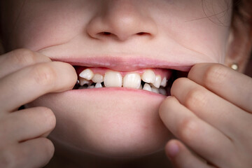 A young girl smiles and shows her crooked teeth. Mouth close-up.