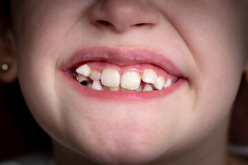 A young girl smiles and shows her crooked teeth. Mouth close-up.