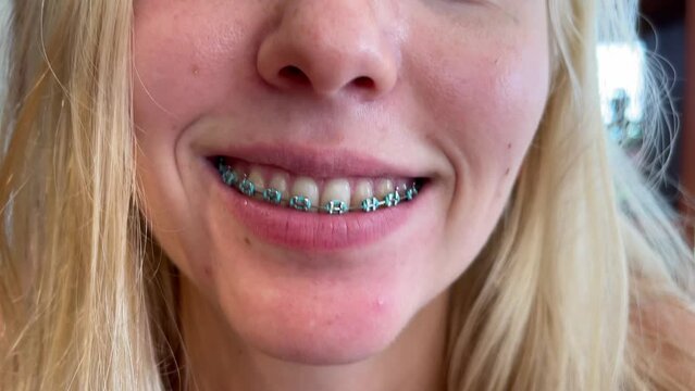 Teeth with braces. Dental care concept. Close-up of a wide smile of a girl with braces on snow-white teeth. The concept of caring for teeth and oral cavity. Problems with bite, alignment of teeth.