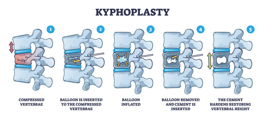 Kyphoplasty invasive surgery for spinal compression fracture treatment outline diagram. Labeled educational medical procedure for vertebrae reconstruction with balloon and cement vector illustration. - obrazy, fototapety, plakaty