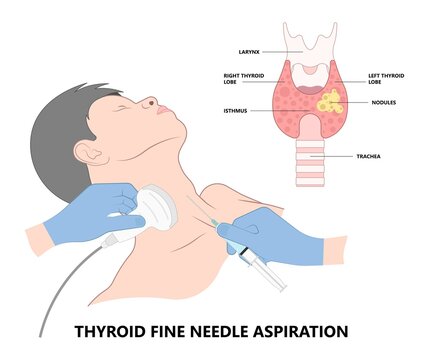 Thyroid cancer disease nodules ultrasound screening check medical treat fine needle aspiration lumps test lab gland neck pain Graves FNA FNAB Large Toxic diagnostic exam collect lymph nodes cell