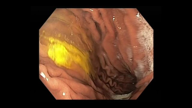 Esophagogastroduodenoscopy Procedure Showing View Inside The Human Esophagus Through A Small Flexible Endoscope Inserted Through The Mouth. macro