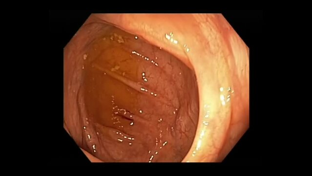 Water Used To Distend The Colon During Colonoscopy To Visualize The Way Forward. macro