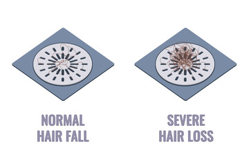 Hair clumps stuck in the shower drain grids. Normal hair fall versus severe hair loss. Alopecia symptom concept. Cartoon vector illustration