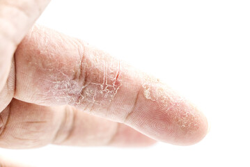 index finger skin disease on white background