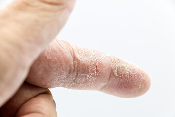 index finger skin disease on white background